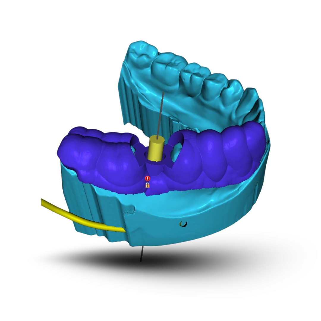 Tooth supported Surgical Guide