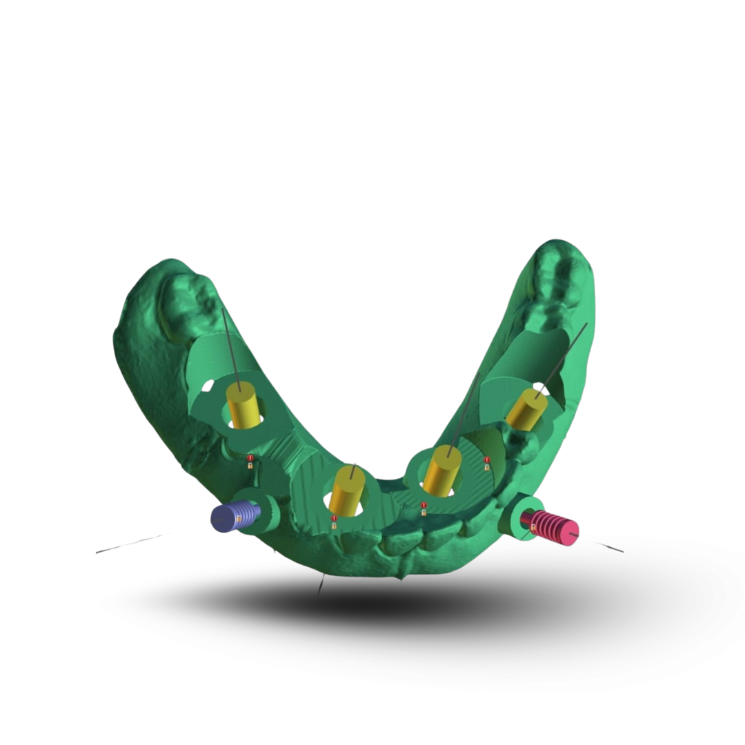 Tissue Supported Guide Design