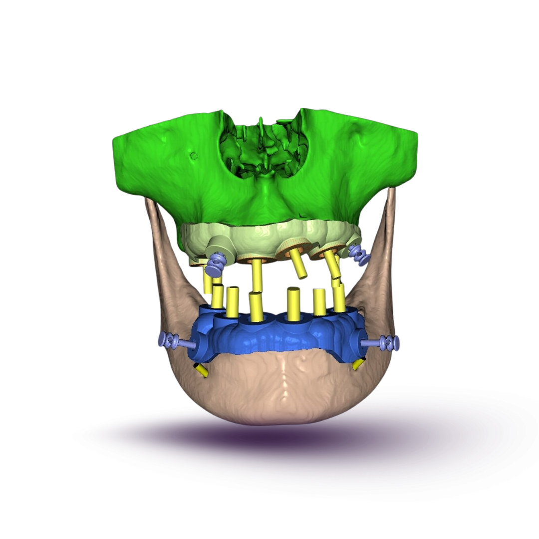 Bone Supported Guide Design