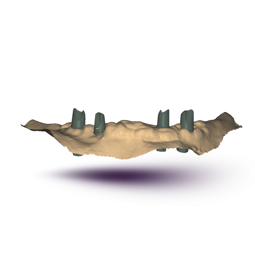 custom implant