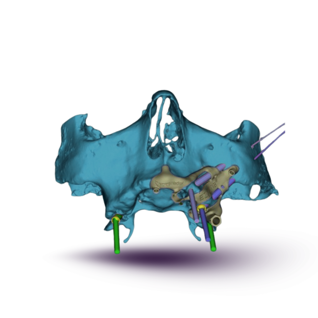 pterygoid