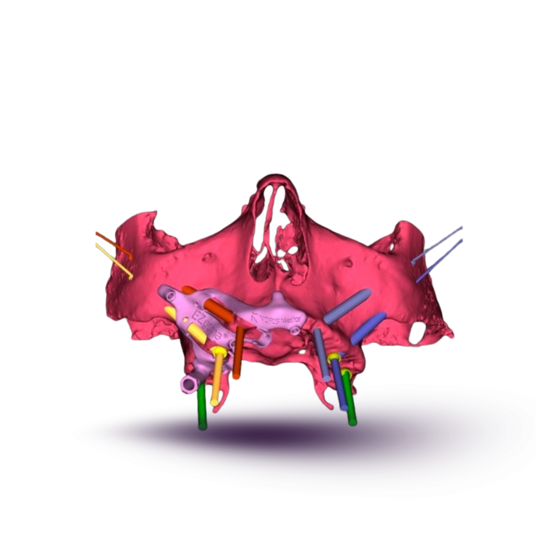 zygomatic