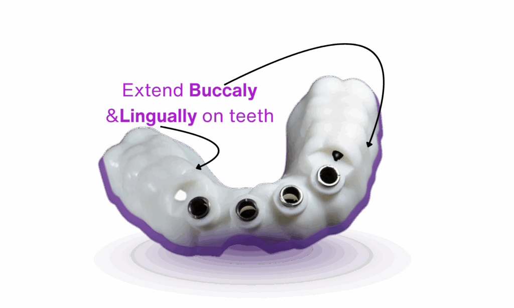 extend the guide lingually and buccally on teeth of implant surgical guide